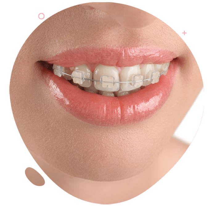 https://dev.passiondentalcare.com/wp-content/uploads/2022/12/bracket-ceramic-images-min.png