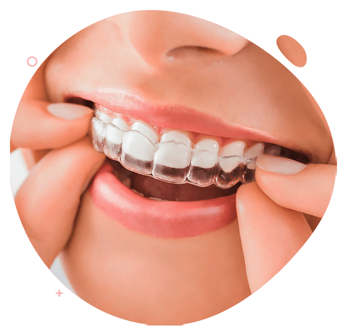 https://dev.passiondentalcare.com/wp-content/uploads/2022/12/bracket-klar-clear-aligner-images-min.png