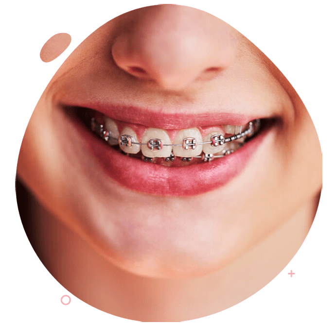 https://dev.passiondentalcare.com/wp-content/uploads/2022/12/bracket-metal-images-min.png