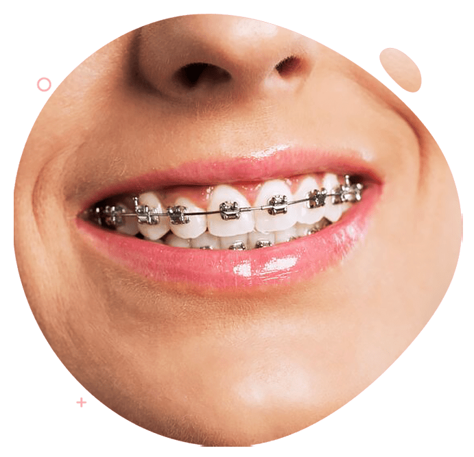 https://dev.passiondentalcare.com/wp-content/uploads/2022/12/bracket-self-ligating-images-pdc.png