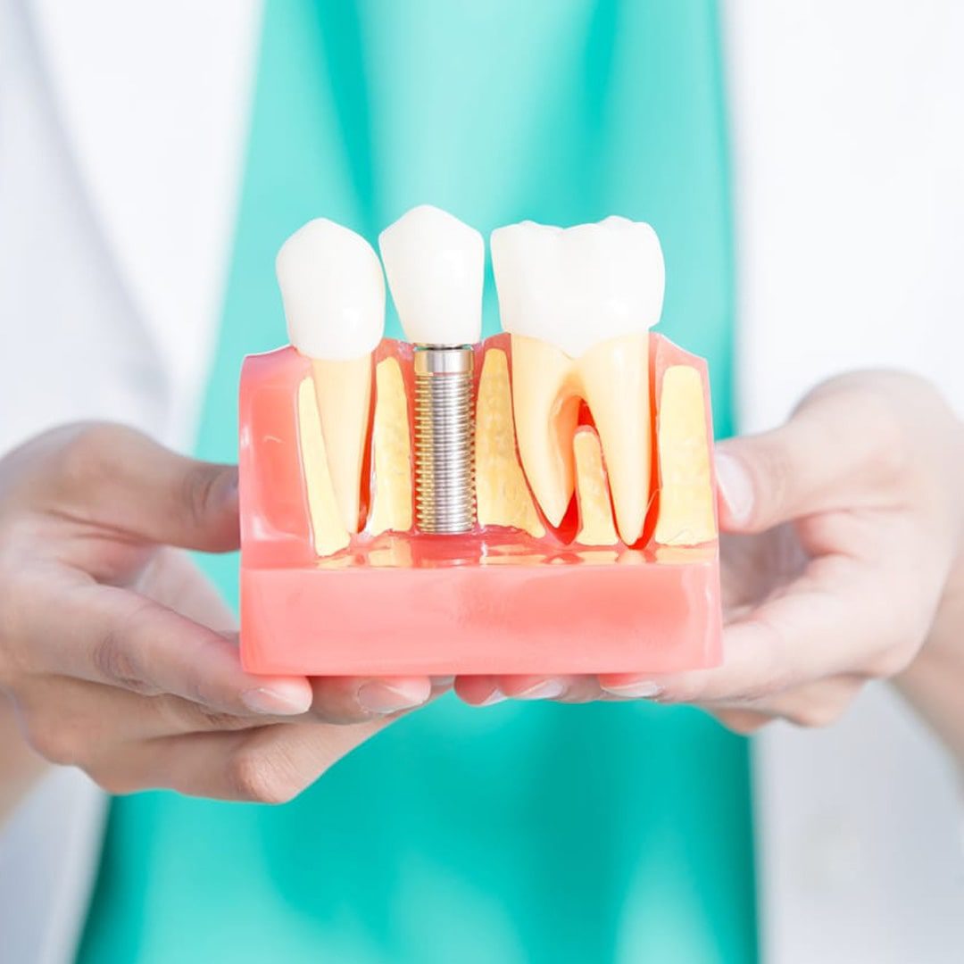 https://dev.passiondentalcare.com/wp-content/uploads/2022/12/implan-gigi-images-1-min.jpg