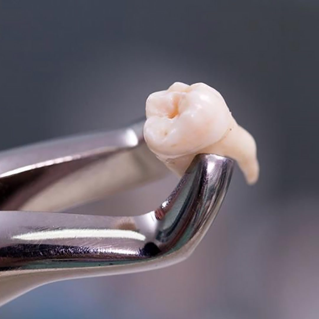 https://dev.passiondentalcare.com/wp-content/uploads/2022/12/pencabutan-gigi-images-2-min.jpg