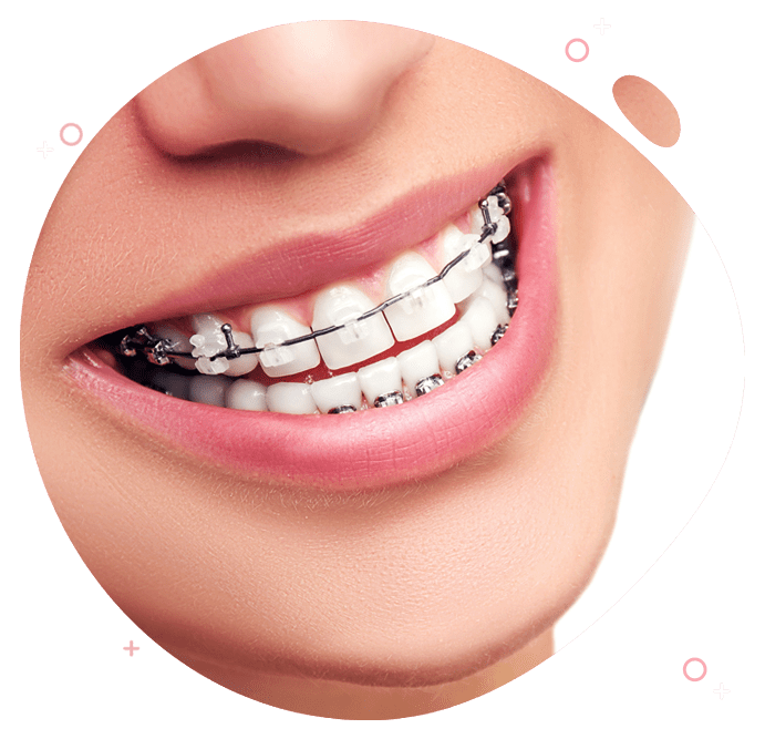 https://dev.passiondentalcare.com/wp-content/uploads/2023/05/behel-images.png