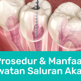 Article Apa Itu Perawatan Saluran Akar Gigi | Passion Dental Care